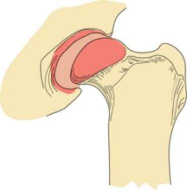 A drawing of the shoulder joint with an area in it.