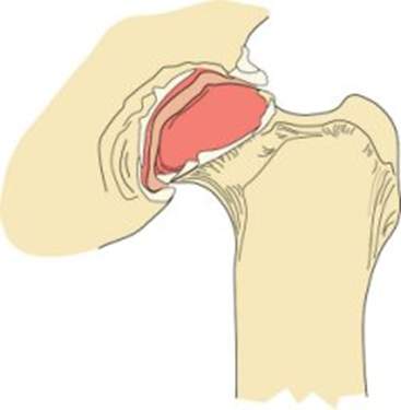 A drawing of the inside of a shoulder joint.